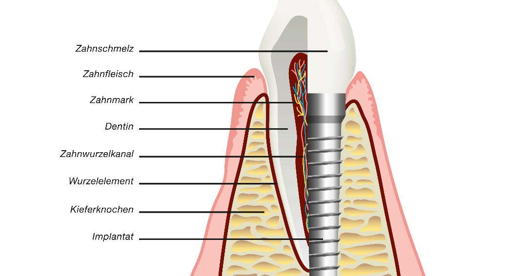 Zahnimplantat Beschreibung Sopron