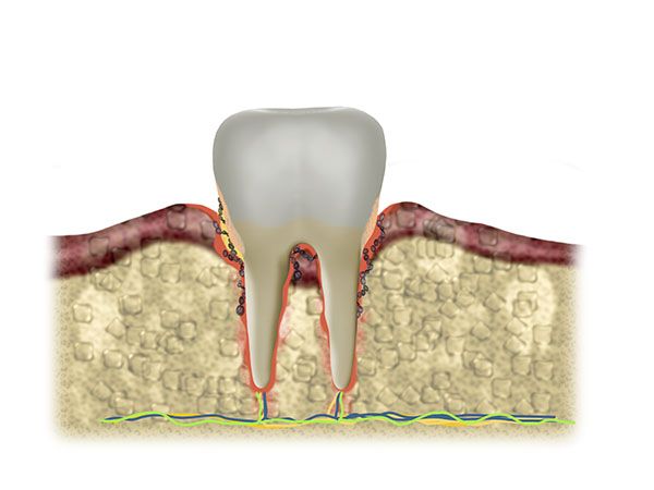 Fogínygyulladás - Soproni fogorvos